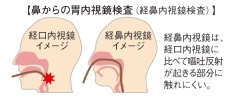 胃内視鏡